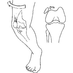 pattelar dislocation1