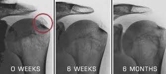 Calcific tendinopathy